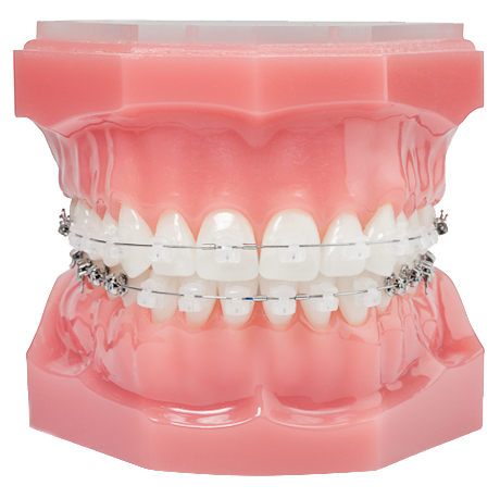Damon Braces