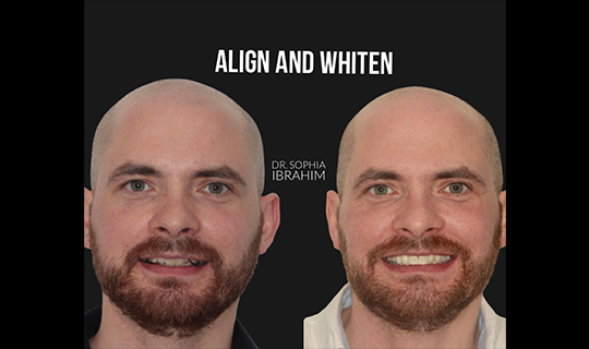 Smile Makeover case1