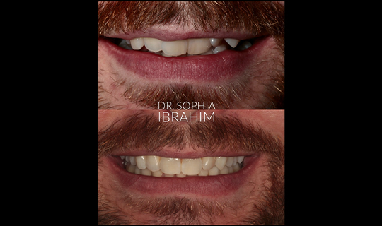 Smile Makeover case2